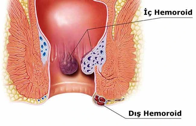 basur hemoroid çeşitleri