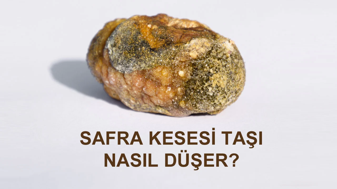 Safra kesesi taşı nasıl düşürülür